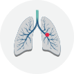 NSCLC